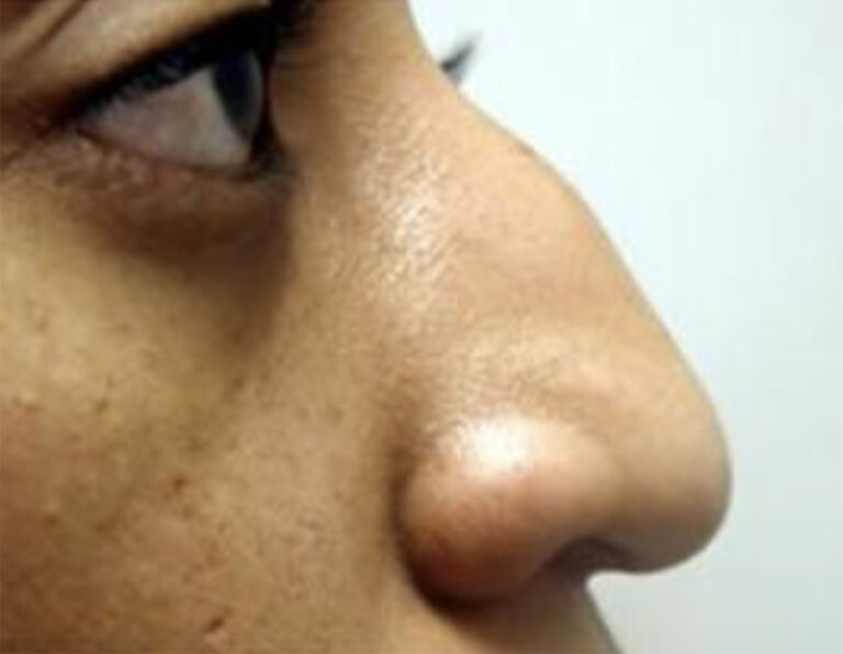 Before Image: Nasal Reconstruction - right-side