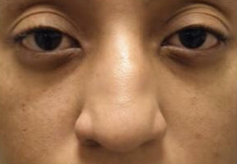 Before Image: Nasal Reconstruction - front